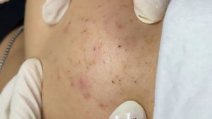 188 • Acne collection • АСМР • Relax Spa