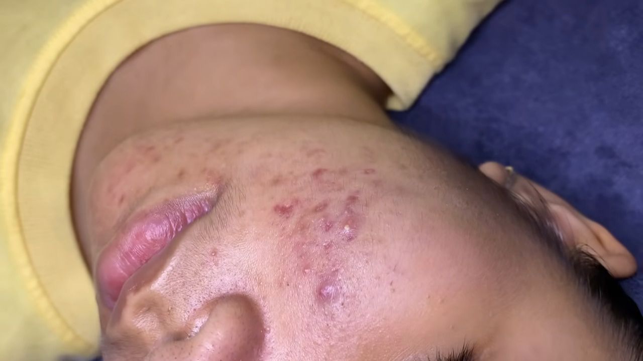 180 • Acne collection • АСМР • Relax Spa смотреть онлайн