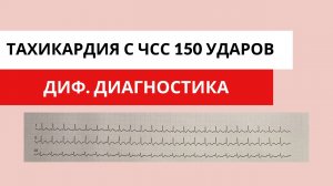 Наджелудочковая тахикардия с ЧСС 150 ударов в минуту. Диф. диагностика.