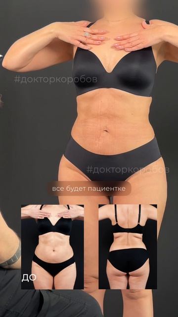 1 месяц после липомоделирования тела 🔥