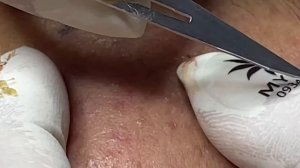 Механическое очищение пор от acne.