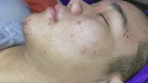#116 Удаление прыщей. Экстрация комедонов. Подкожные прыщи. Чистка от черных точек