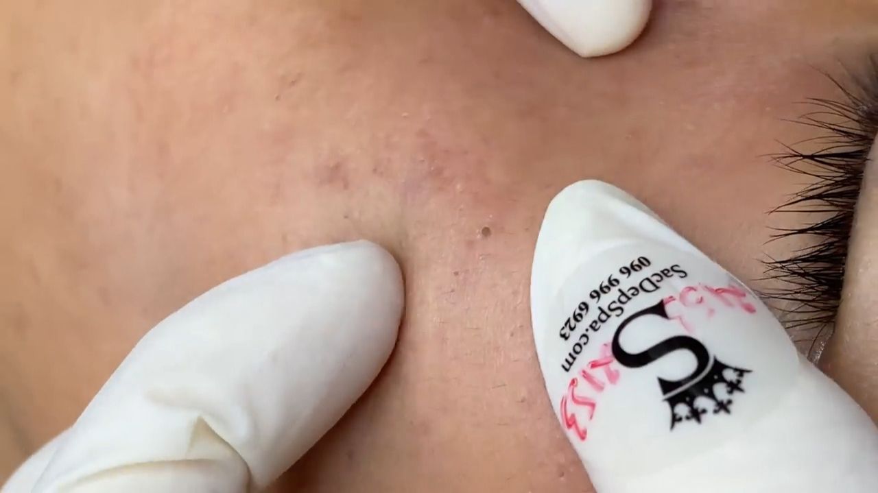 185 • Acne collection • АСМР • Relax Spa смотреть онлайн