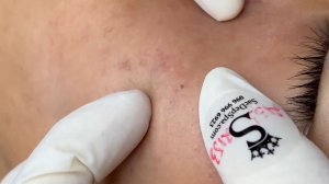 185 • Acne collection • АСМР • Relax Spa