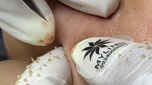 Asmr. Механическое очищение от скрытых прыщей.