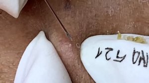 #115 Удаление прыщей. Экстрация комедонов. Подкожные прыщи. Чистка от черных точек
