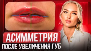 Асимметрия после увеличения губ — ошибка или анатомия?