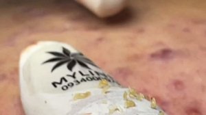 Asmr. Профессиональное удаление от акне.