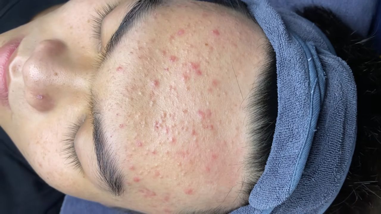 184 • Acne collection • АСМР • Relax Spa смотреть онлайн
