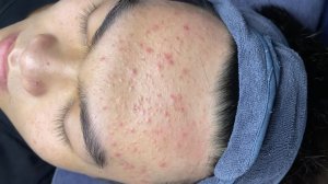 184 • Acne collection • АСМР • Relax Spa