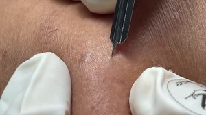 Тихая экстракция черных точек и лечение акне