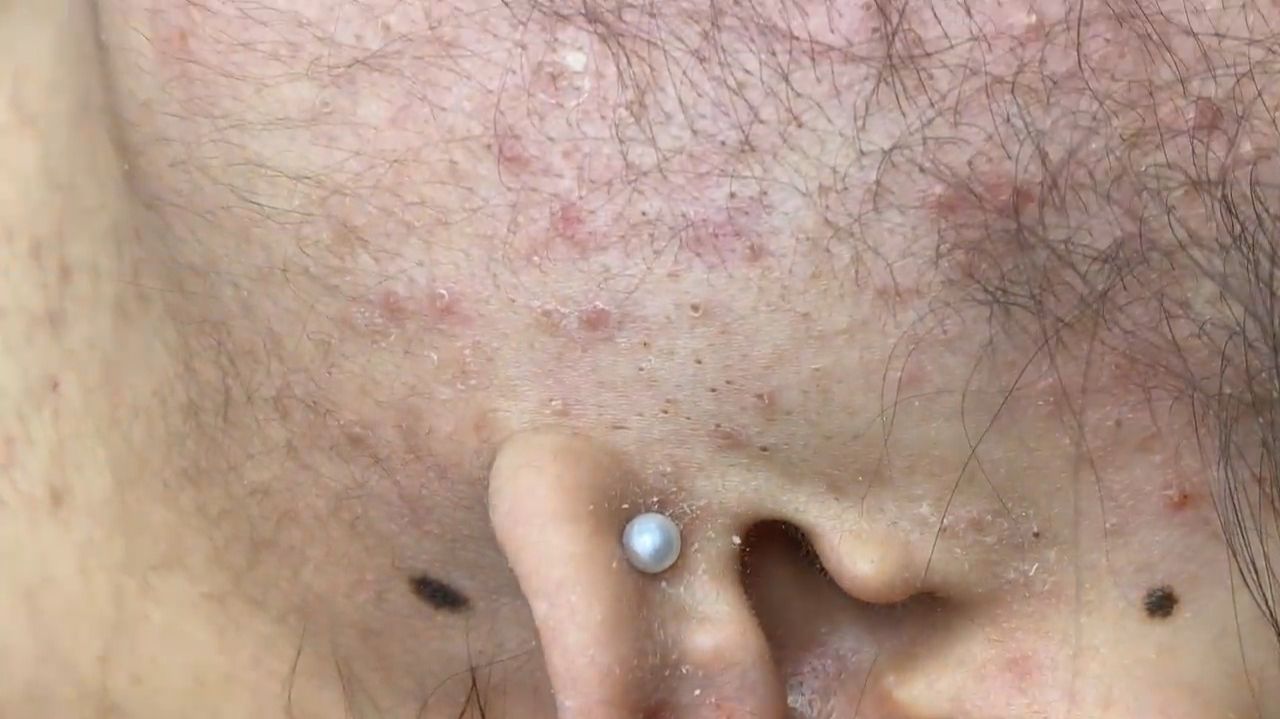 182 • Acne collection • АСМР • Relax Spa смотреть онлайн
