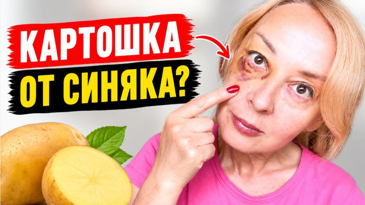 Убираем синяк быстро и просто: понадобится картофель