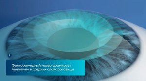 Этапы коррекции зрения
