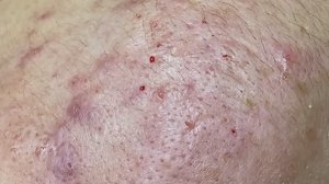 #121 Удаление прыщей. Экстрация комедонов. Подкожные прыщи. Чистка от черных точек