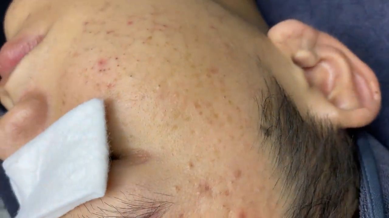 186 • Acne collection • АСМР • Relax Spa смотреть онлайн