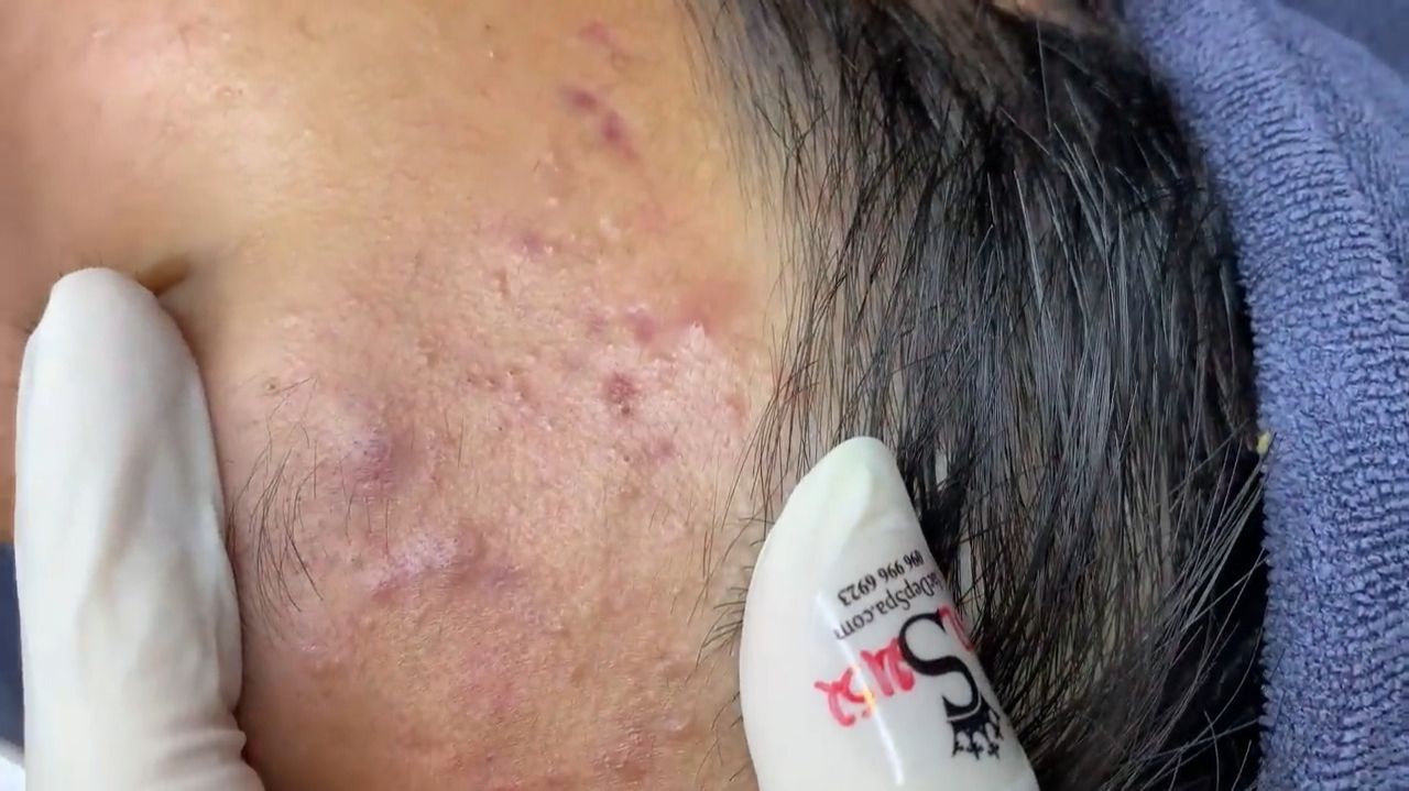 183 • Acne collection • АСМР • Relax Spa смотреть онлайн