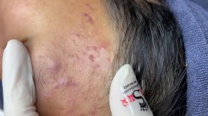 183 • Acne collection • АСМР • Relax Spa