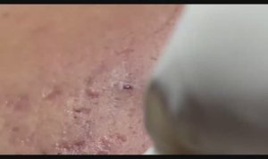 Удаление черных точек и прыщей пошагово