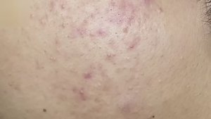 #131 Удаление прыщей. Экстрация комедонов. Подкожные прыщи. Чистка от черных точек