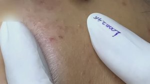 #135 Удаление прыщей. Экстрация комедонов. Подкожные прыщи. Чистка от черных точек
