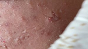 Удаление открытых комедонов (черных точек) и воспаленных прыщей