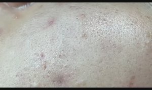 Зачистка лица от черных точек и прыщей