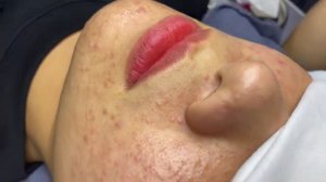 191 • Acne collection • АСМР • Relax Spa
