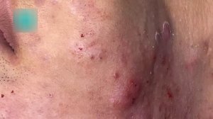 Удаление черных точек и лечение акне у косметолога