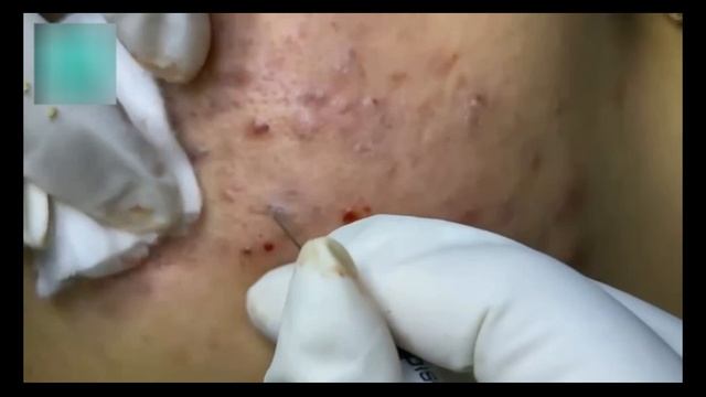 Удаление черных точек и акне для жирной кожи смотреть онлайн