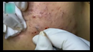 Удаление черных точек и акне для жирной кожи