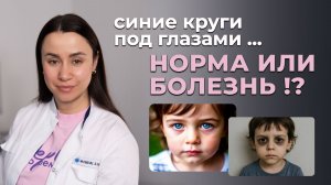 Синяки под глазами у детей: норма, анемия или скрытая болезнь?