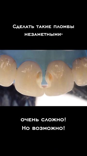 Скрытый кариес под старой пломбой: реальный случай