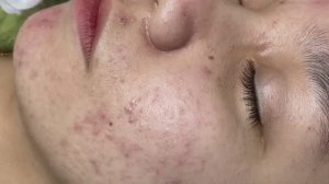 Удаление черных точек и лечение прыщей