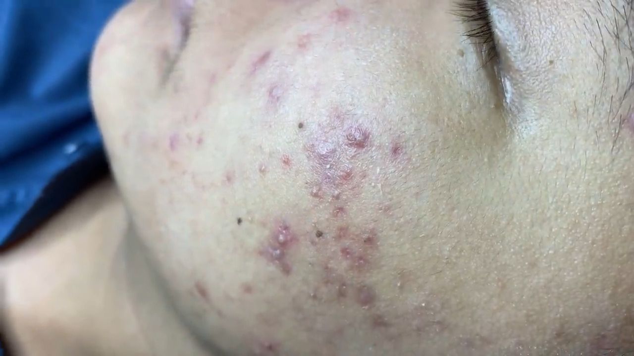 181 • Acne collection • АСМР • Relax Spa смотреть онлайн