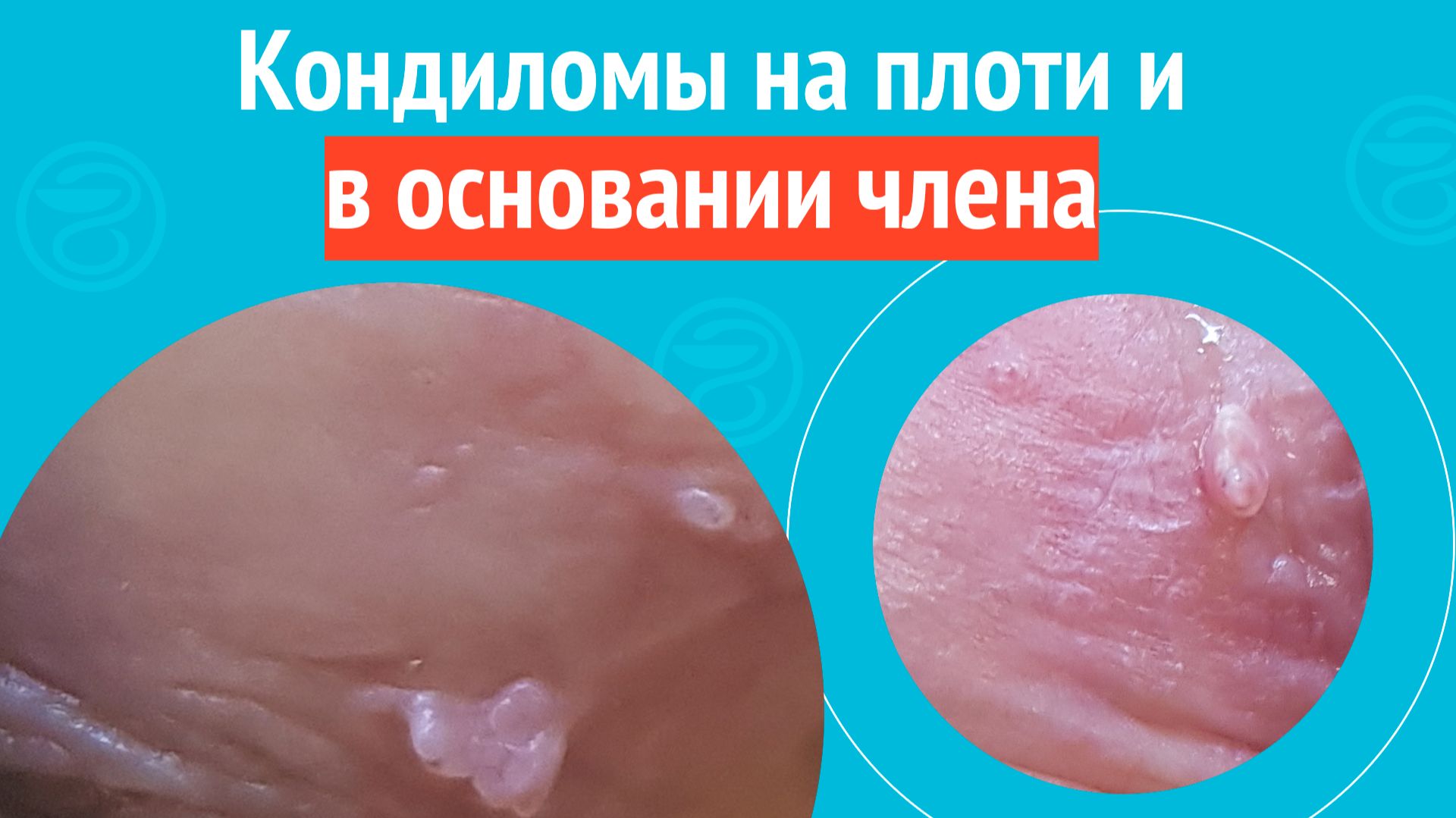 😯 Кондиломы на плоти и в основании члена. Клинический случай № 1798