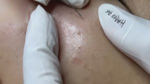#154 Удаление прыщей. Экстрация комедонов. Подкожные прыщи. Чистка от черных точек