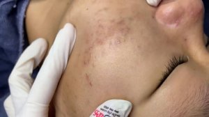 190 • Acne collection • АСМР • Relax Spa
