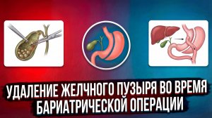 Удаление желчного пузыря во время бариатрической операции