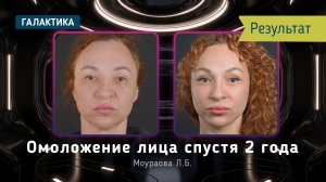 Омоложение лица спустя 2 года | Результат Deep Plane лифтинга у Ларисы Моураовой