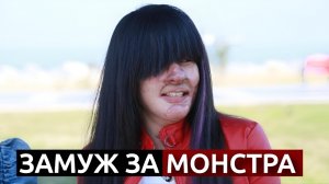 Шокирующая история девушки, которую облили кислотой