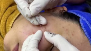 Удаление черных точек на лице девушки