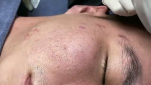 Удаление прыщей, комедонов, акне для жирной кожи