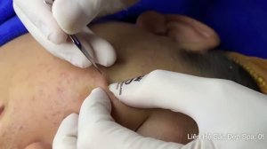 Быстрый способ удаления черных точек