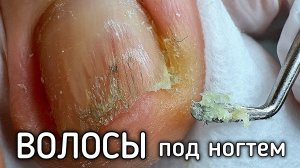 узкая обувь,подногтевые мозоли,скрученные ногти. Причину клиент не убирает,работаю со следствием ❤️