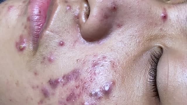 #162 Удаление прыщей. Экстрация комедонов. Подкожные прыщи. Чистка от черных точек смотреть онлайн
