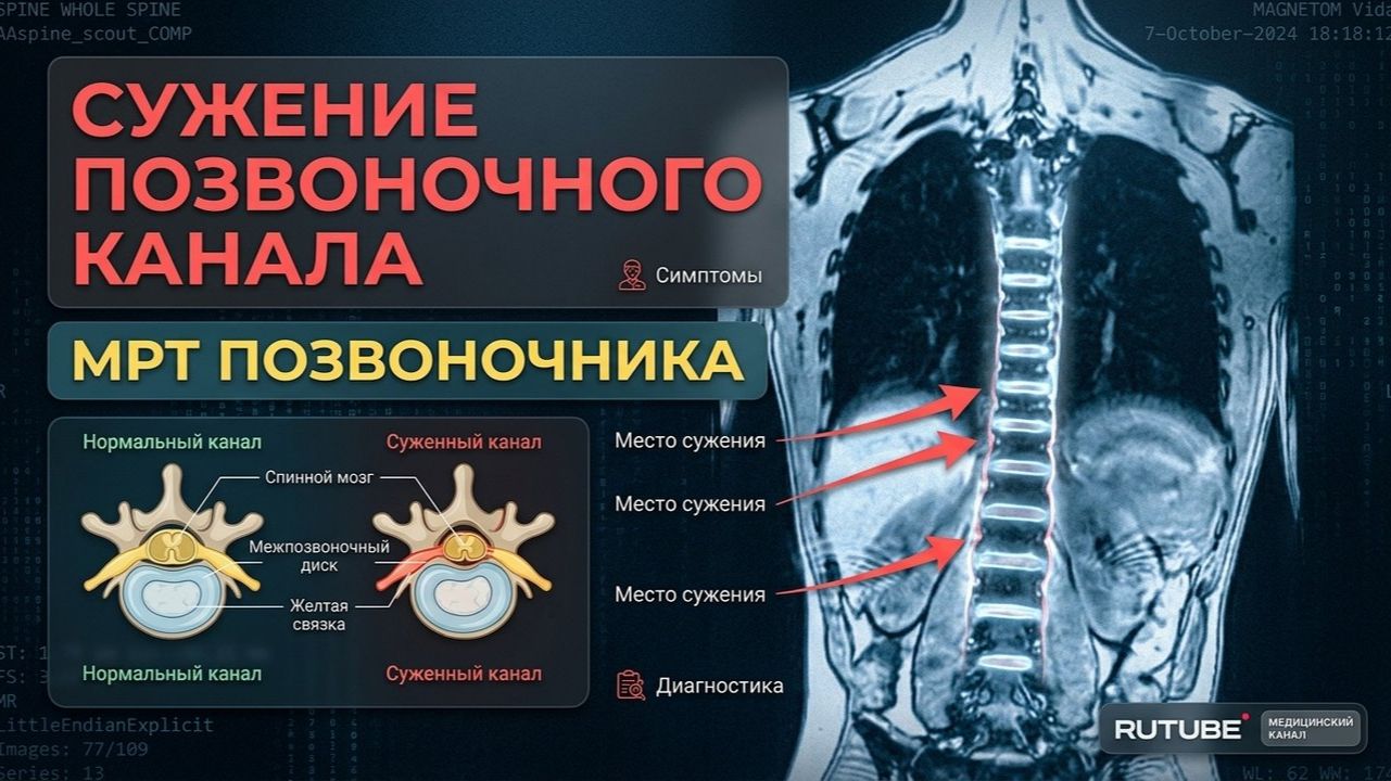 БОЛИ В СПИНЕ при узком ПОЗВОНОЧНОМ КАНАЛЕ и межпозвоночных ГРЫЖАХ на расшифровке МРТ позвоночника