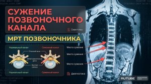БОЛИ В СПИНЕ при узком ПОЗВОНОЧНОМ КАНАЛЕ и межпозвоночных ГРЫЖАХ на расшифровке МРТ позвоночника