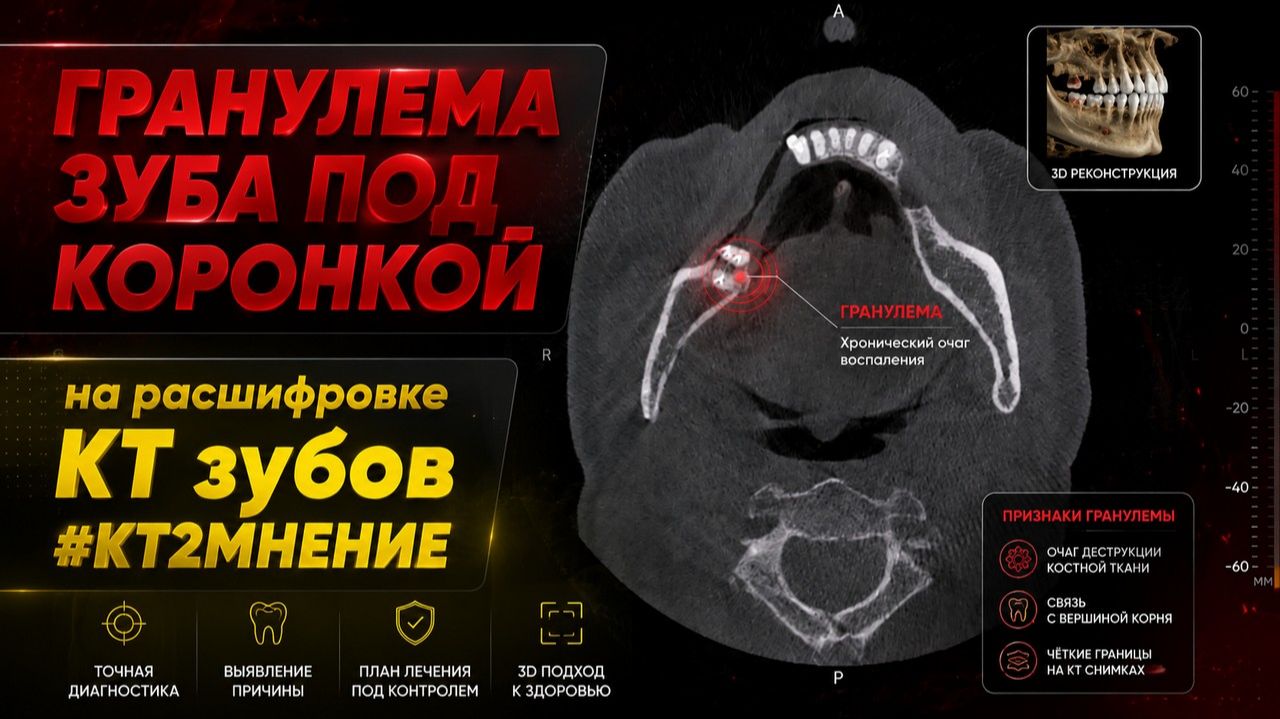 БОЛИТ десна ВОСПАЛЕНИЕ ДЕСНЫ после удаления зуба ГРАНУЛЕМА ЗУБА под коронкой на РАСШИФРОВКЕ КТ зубов