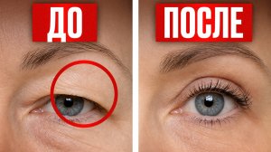Убери НАВИСШЕЕ ВЕКО всего за 1 НЕДЕЛЮ! Почему блефаропластика БЕЗОБИДНЕЕ ДОМАШНИХ ПРОЦЕДУР